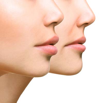 lip-augmentation