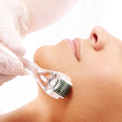 microneedling