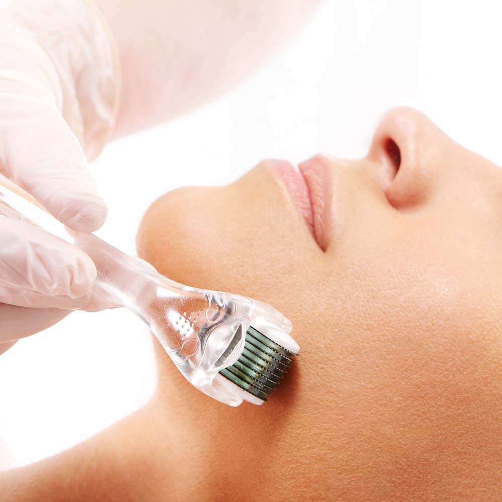 microneedling-derby
